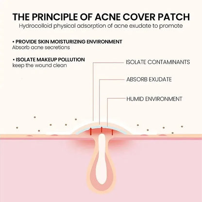 Acne Pimple Patches