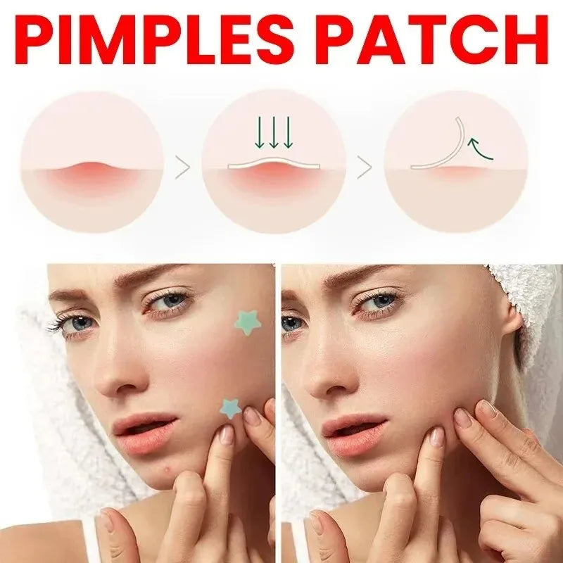 Acne Pimple Patches