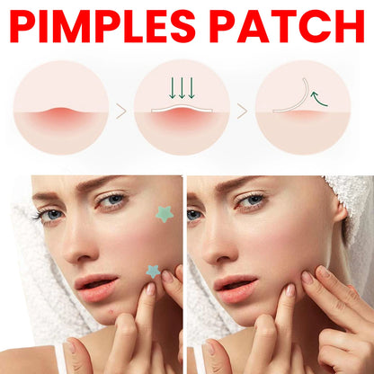 Acne Pimple Patches