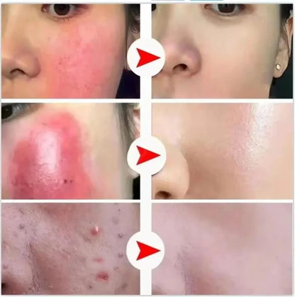 Facial Redness Reduce Cream Improve Sensitive Skin Dryness